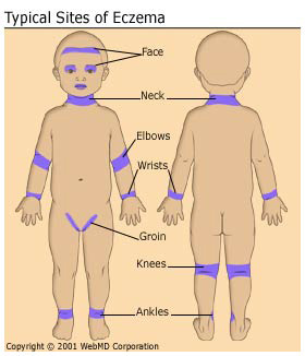 Treatment of Baby Eczema