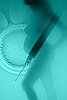 IVF and Abortion
