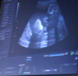 When Baby Fails the Heartbeat Test