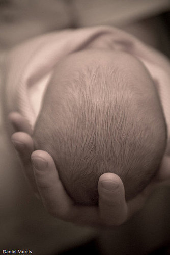 Cradle Cap Cradle Cap
