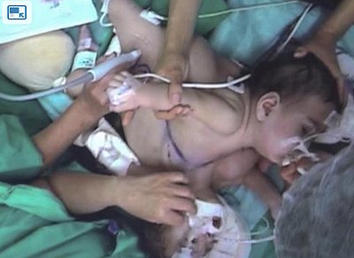 Conjoined Twins Separated in Televised 18-Hour Surgery 