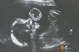 Doctors Save Baby In Utero with First-of-its-Kind Surgery