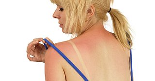 10 Ways to Soothe a Sunburn