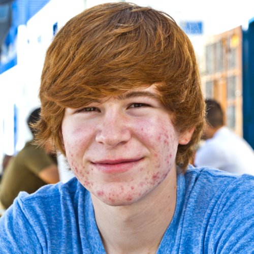 Teen Acne Treatments