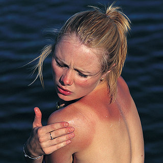 Natural Sunburn Remedies