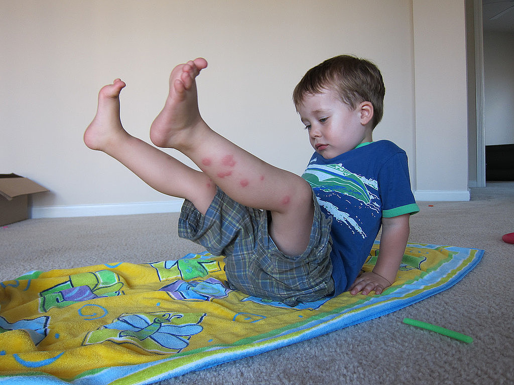 Eight Home Remedies For Bug Bites Eight Home Remedies For Bug Bites