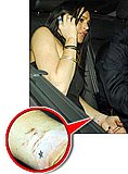 Is Lindsay self harming?