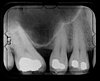 Have You Ever Had a Root Canal?
