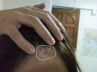 Healing Help For Chemical Burns