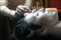 Acufacials - The Hottest New Beauty Trend