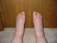 Ankle Liposuction for Cankles