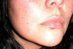 How to Prevent Cold Sores
