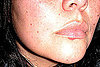 How to Prevent Cold Sores