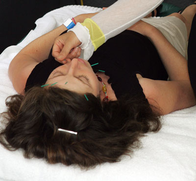 Exercise and Acupuncture Help PCOS