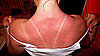 How to Avoid Sun Poisoning