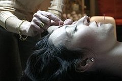 Acufacials - The Hottest New Beauty Trend