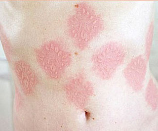 Turning Lemons Into Lemonade: Skin Art 