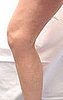 What are varicose veins?