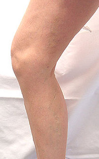 What are varicose veins?