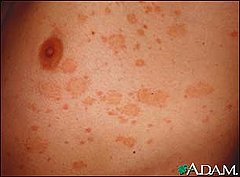 Common Skin Problem: Pityriasis Rosea