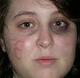 McCain Volunteer Says She Was Mugged, Had 'B' Cut in Her Face