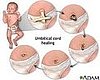 Umbilical Cord Quiz