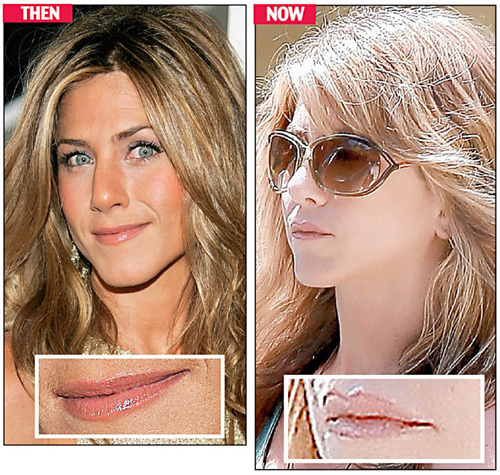 Jennifer Aniston Got New Lips