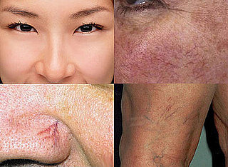 Broken Capillary