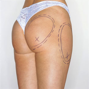 Vanity Poll: Would You Try SmartLipo?
