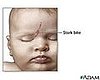 Birthmarks and Stork Bites