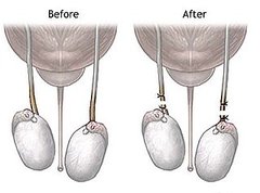 What Do You Know About the Unloved Vasectomy? 