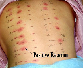 Testing For Allergies - No Need for the Pricks?