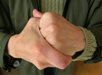 Does Cracking Your Knuckles Cause Arthritis?