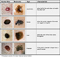 4 Warning Signs of Skin Cancer