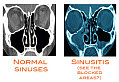Allergies and Chronic Sinusitis