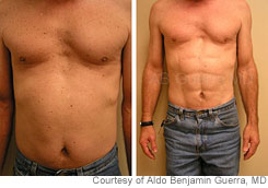 Six-Pack Surgery? 