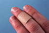Wart information, removal tips