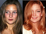 Has Kate Hudson had a nose job?