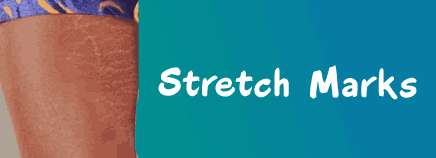 Stretch Marks Be Gone