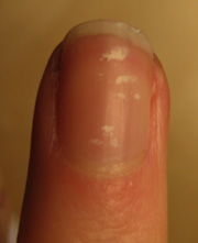 What Are Those White Spots in My Nails?
