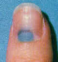 How Long Will It Take A Mark To Grow Out Of Your Nail?