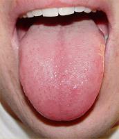Got a Bumpy Tongue?