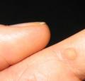 Don't Touch That Wart